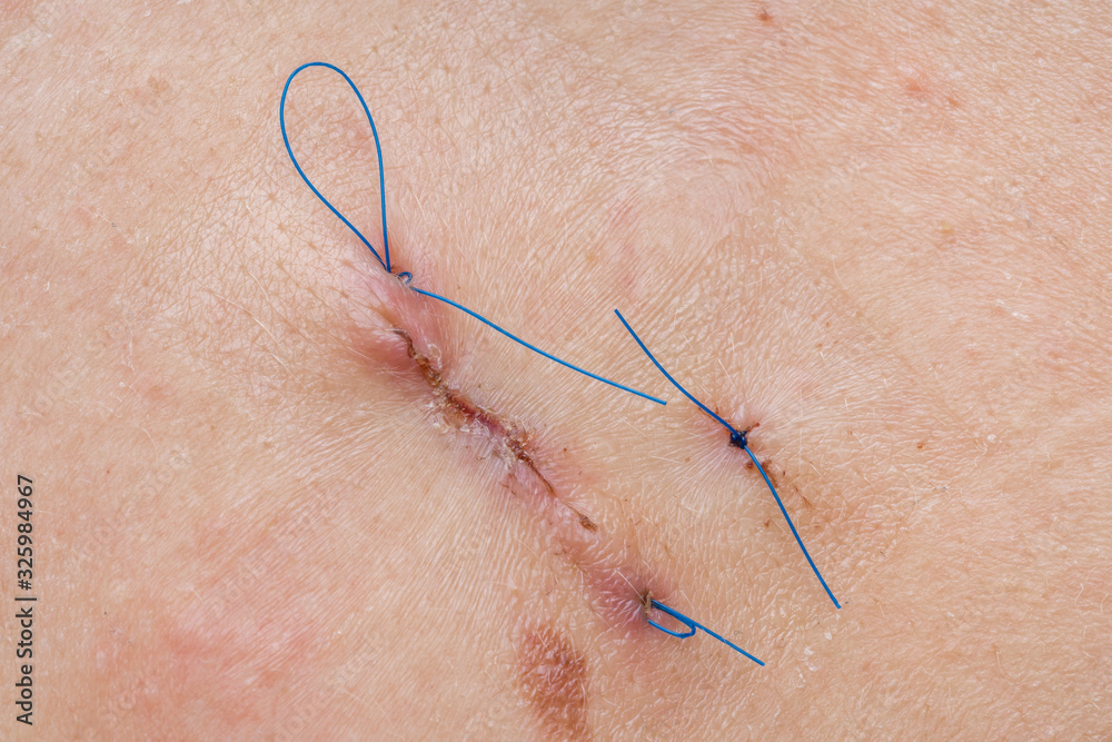Medical scar with blue thread after surgery operation Medical scar with blue thread after surgery operation