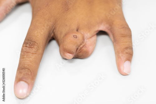 Abnormal fingers caused by genetic diseases for education in laboratories. photo