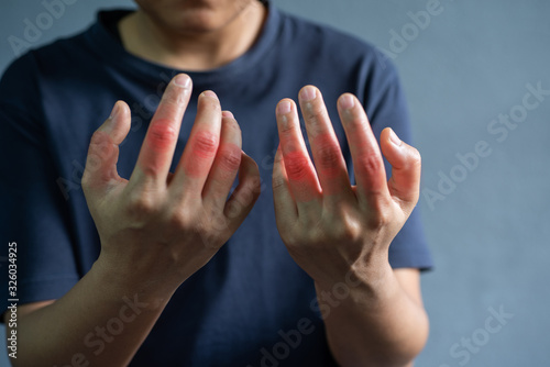 Painful hands patient gout on grey background. © toeytoey