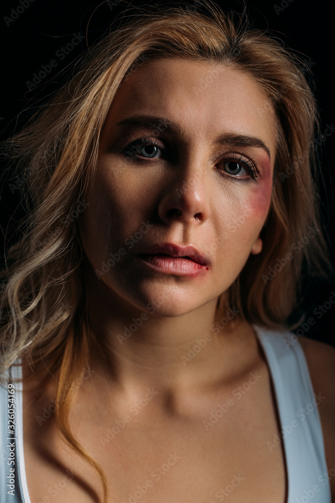 Frustrated Victim with bruises on face looking at camera isolated on black Frustrated Victim with bruises on face looking at camera isolated on black