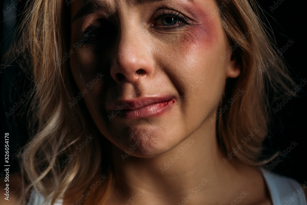 Victim with bruises crying and looking at camera isolated on black Victim with bruises crying and looking at camera isolated on black