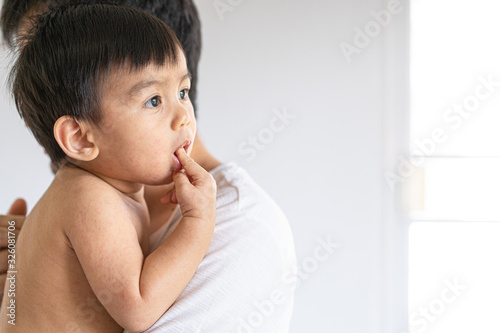 The parent is hugging a sickness asian little baby boy from viral infection skin rash, concept of healthcare, medical and skin problem from viral and hypersensitivity.