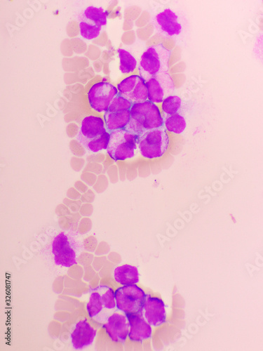 Acute promyelocytic leukemia cells or APL  analyze by microscope  original magnification 1000x