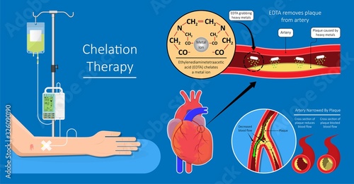 Chelation Therapy lead mercury iron arsenic ethylenediaminetetraacetic acid bloodstream coronary artery disease metal poisoning autism Alzheimer’s diabetes inject agent arteries iv toxic treat vein