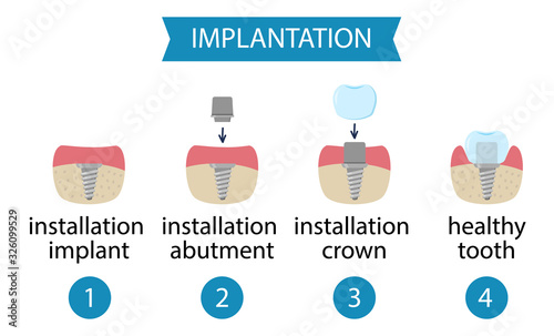 infographics dental implantation. Process of implant installation. Vector Illustration isolated on white.