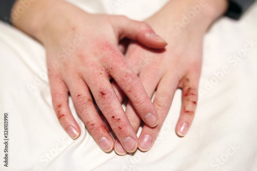 Close up on Hands of Child with Severely Cracked and Dry Skin