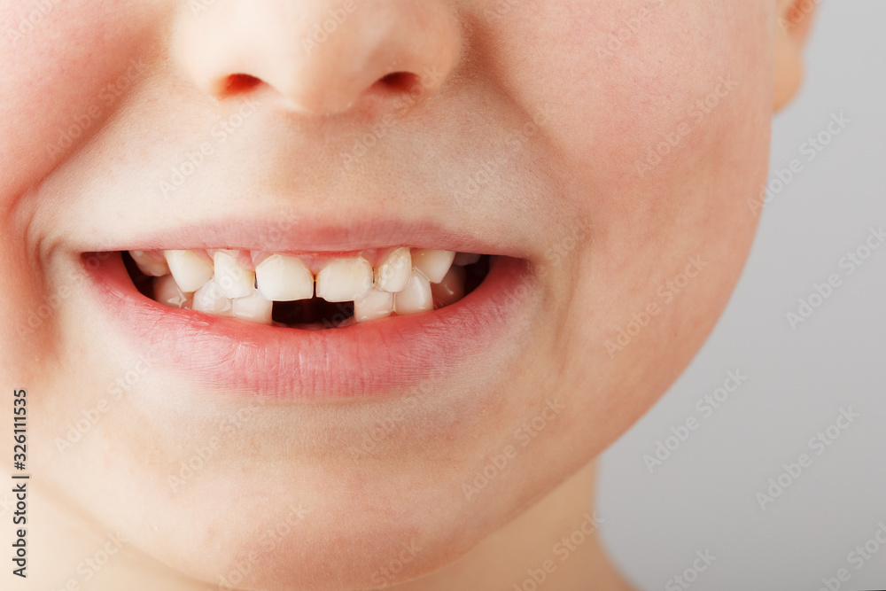 Obraz premium A child's smile without lower baby teeth. A hole in a child's smile. Fun concept.