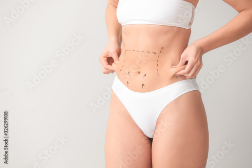 Young woman with marks on her belly against light background. Concept of plastic surgery