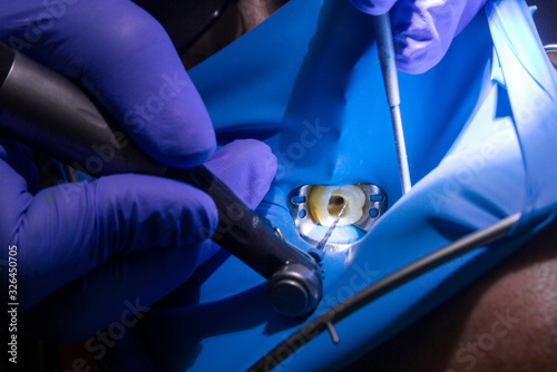 Treatment of dental canals in the upper molar permanent molar using an apex locator file, a tooth with a clip attached to it with a cofferdam. photo