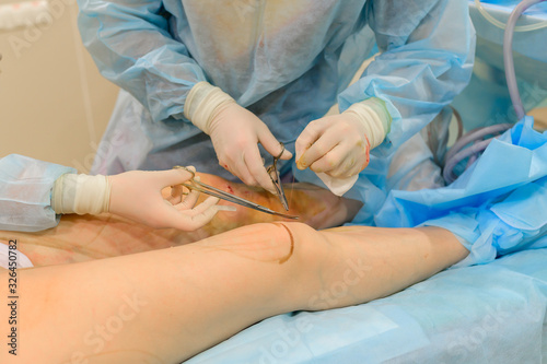 Surgeons suture their knees after liposuction. Close-up of plastic surgery to remove excess fat.