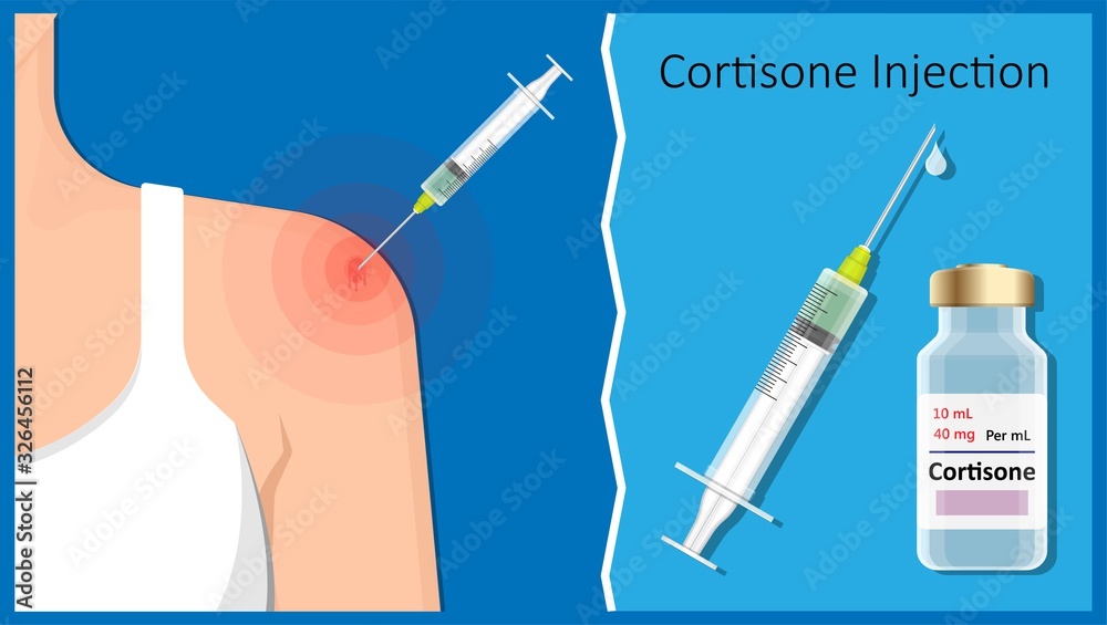 Cortisone shots injection epidural steroid ESI lumbar back spinal