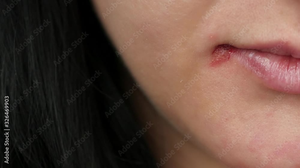 Part of a woman's face with the herpes virus, a bloody wound. Health and medicine. Part of a woman's face with the herpes virus, a bloody wound. Health and medicine.