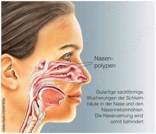 Foto Nasenpolypen