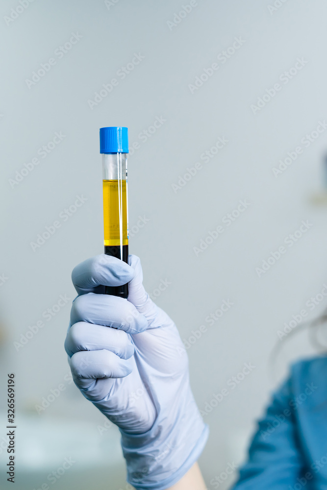 Hand girl doctor glove holds test tube with blood plasma Hand girl doctor glove holds test tube with blood plasma