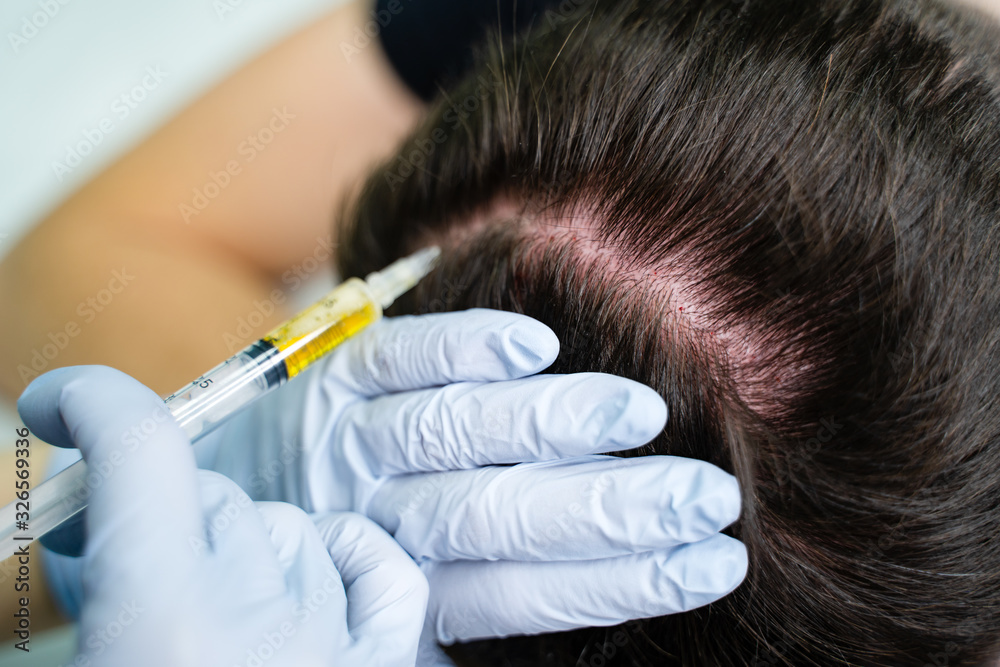 Injection plasma into head hair man cosmetologist doctor Injection plasma into head hair man cosmetologist doctor