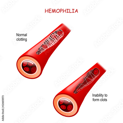 Haemophilia. hemophilia. healthy blood vessel after bleeding and blood vessel with Coagulation disorder.