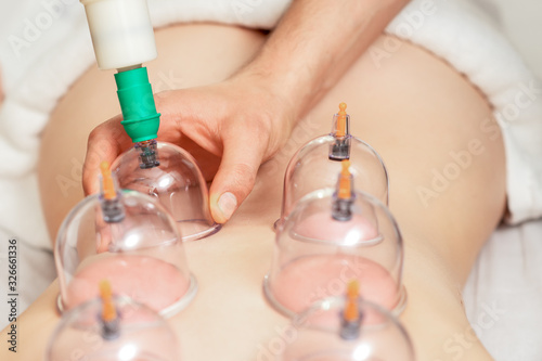 Hand puts on vacuum cups of medical cupping therapy on woman s back  close up  chinese medicine.
