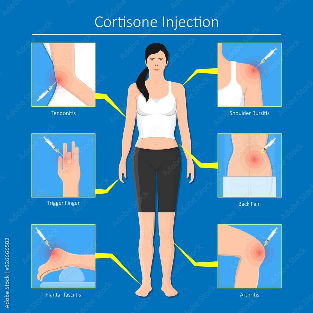 Cortisone shots injection epidural steroid ESI lumbar back spinal