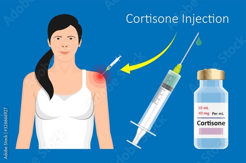 Cortisone shots injection epidural steroid ESI lumbar back spinal nerves anti inflammatory Carpal Tunnel Syndrome tennis elbow symptom swelling chronic discomfort