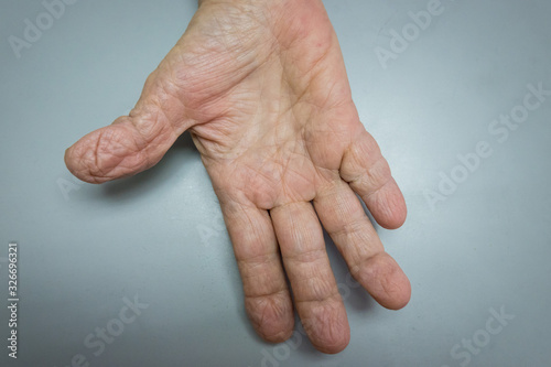 Mature patient with osteoarthritis photo