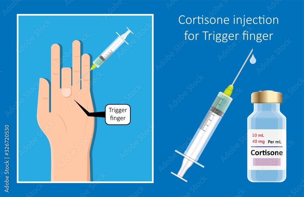 Vecteur Stock Cortisone shots injection epidural steroid ESI lumbar