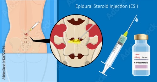 Cortisone shots injection epidural steroid ESI lumbar back spinal nerves anti inflammatory Carpal Tunnel Syndrome tennis elbow symptom swelling chronic discomfort