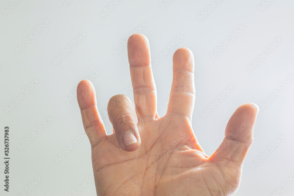 Trigger Finger a defect in a tendon causing a finger to jerk or snap straight when the hand is extended. Trigger Finger a defect in a tendon causing a finger to jerk or snap straight when the hand is extended.