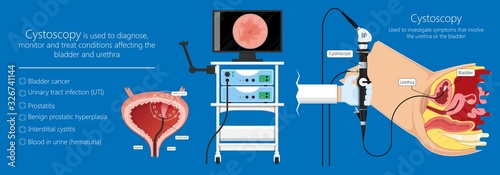 Cystoscopy diagnose bladder diseases and conditions exam treat benign prostatic hyperplasia BPH painful urology urethritis endoscopy urination endoscopic