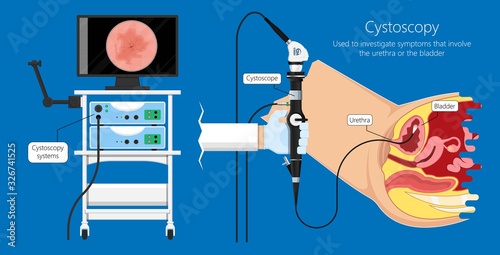 Cystoscopy diagnose bladder diseases and conditions exam treat benign prostatic hyperplasia BPH painful urology urethritis endoscopy urination endoscopic