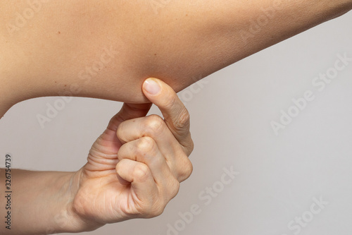 Fatty triceps panels pulled with the fingers of the hand. Excess skin concept after rapid weight loss photo