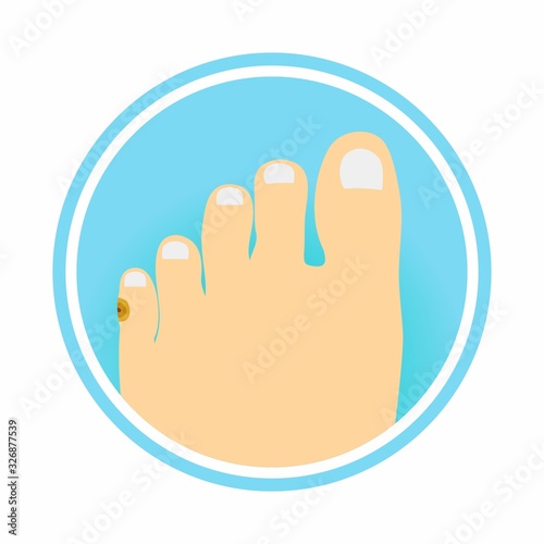 Corn on left pinky toe. Vector illustration