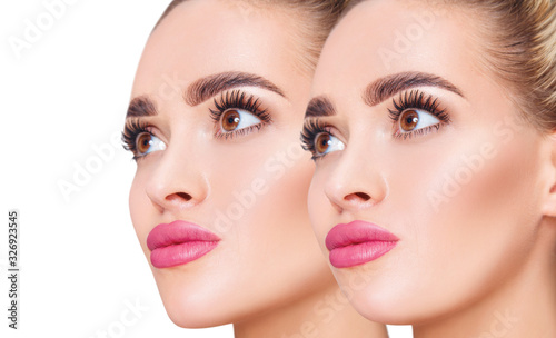 Young woman before and after chin correction.