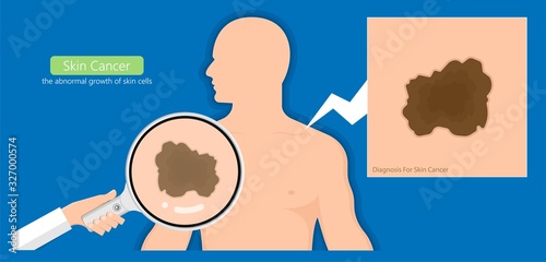 Skin cancer treatment diagnosis medical patient screening