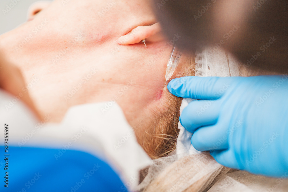 Subcutaneous injection of hyaluronic acid - rejuvenation of the face of an aged woman