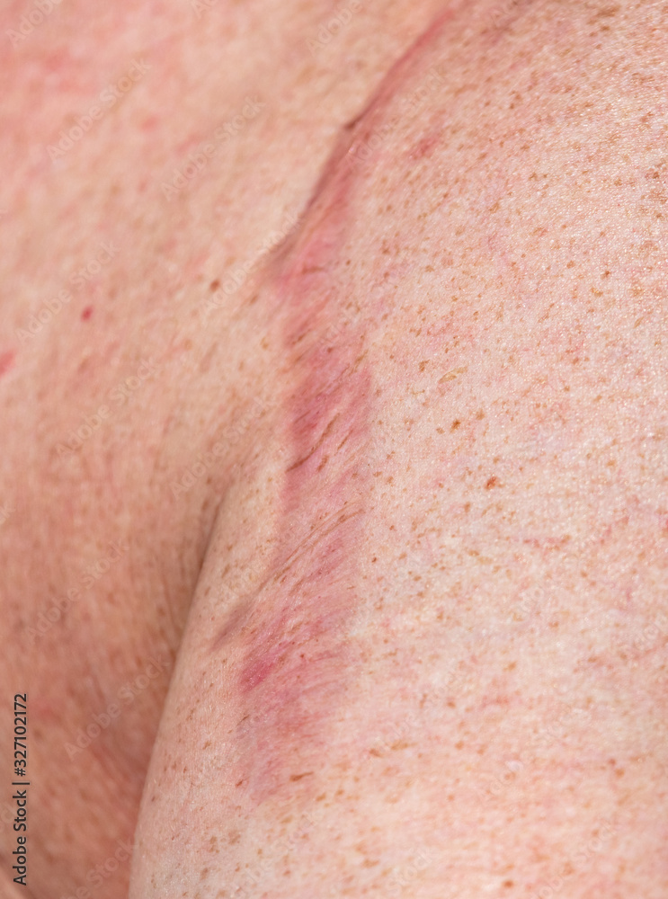 Fototapeta premium A scar on a man’s skin