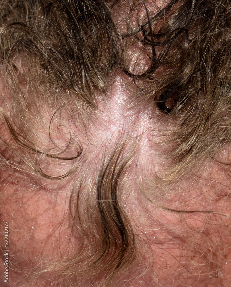 The hair on the head of a man The hair on the head of a man