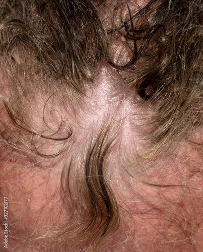 The hair on the head of a man