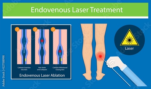 endovenous laser treatment CVD treat ELT legs inject EVLT varicose veins Radiofrequency Ablation RFA	