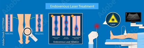 endovenous laser treatment CVD treat ELT legs inject EVLT varicose veins Radiofrequency Ablation RFA	