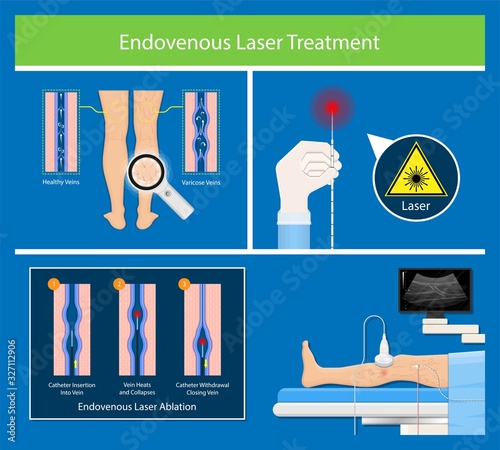 endovenous laser treatment CVD treat ELT legs inject EVLT varicose veins Radiofrequency Ablation RFA	