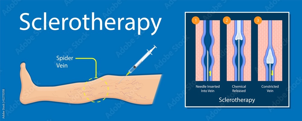 endovenous laser treatment CVD treat ELT legs inject EVLT varicose ...