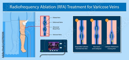 endovenous laser treatment CVD treat ELT legs inject EVLT varicose veins Radiofrequency Ablation RFA	