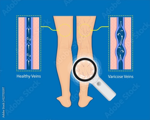 endovenous laser treatment CVD treat ELT legs inject EVLT varicose veins Radiofrequency Ablation RFA	
