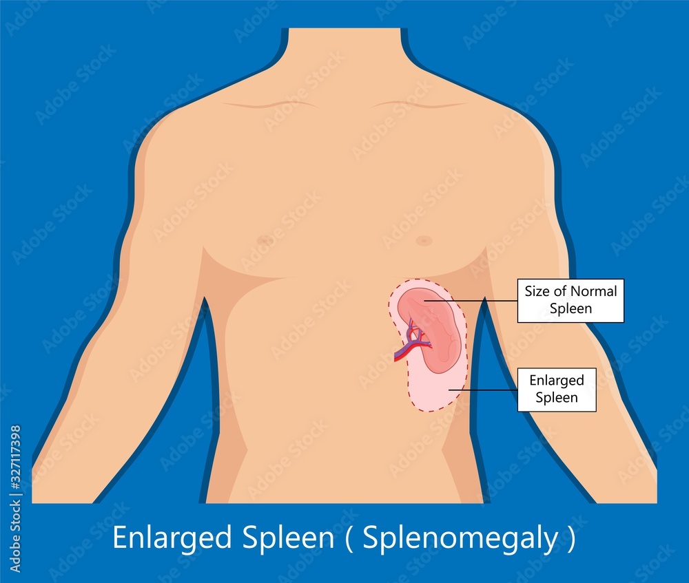 Stockvector Enlarged spleen splenomegaly white blood cells Viral