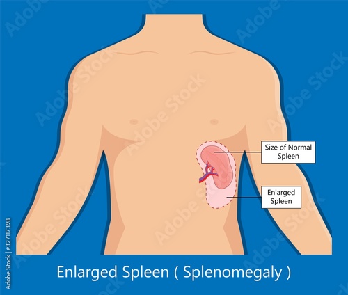 Enlarged spleen splenomegaly white blood cells Viral infection cancer Inflammatory enlargement