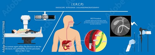 Endoscopic Retrograde Cholangiopancreatography ERCP diagnose treat device bile duct X-rays pancreatic removal material study surgery Tumor cancer infection diagnostic abdominal MRI inject