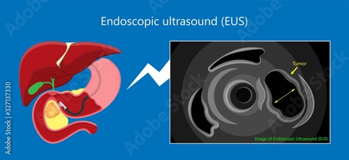 medical endoscopic ultrasound EUS cancer tumor diagnose FNA abdominal test CT scan MRI colon stomach gastric rectal organs examine rectum Acute abnormal esophageal needle pain ulcer pancreas nodule
