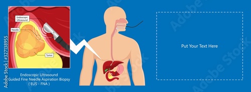 medical endoscopic ultrasound EUS cancer tumor diagnose FNA abdominal test CT scan MRI colon stomach gastric rectal organs examine rectum Acute abnormal esophageal needle pain ulcer pancreas nodule