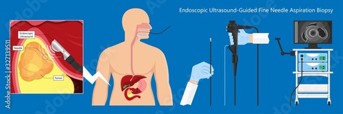 medical endoscopic ultrasound EUS cancer tumor diagnose FNA abdominal test CT scan MRI colon stomach gastric rectal organs examine rectum Acute abnormal esophageal needle pain ulcer pancreas nodule