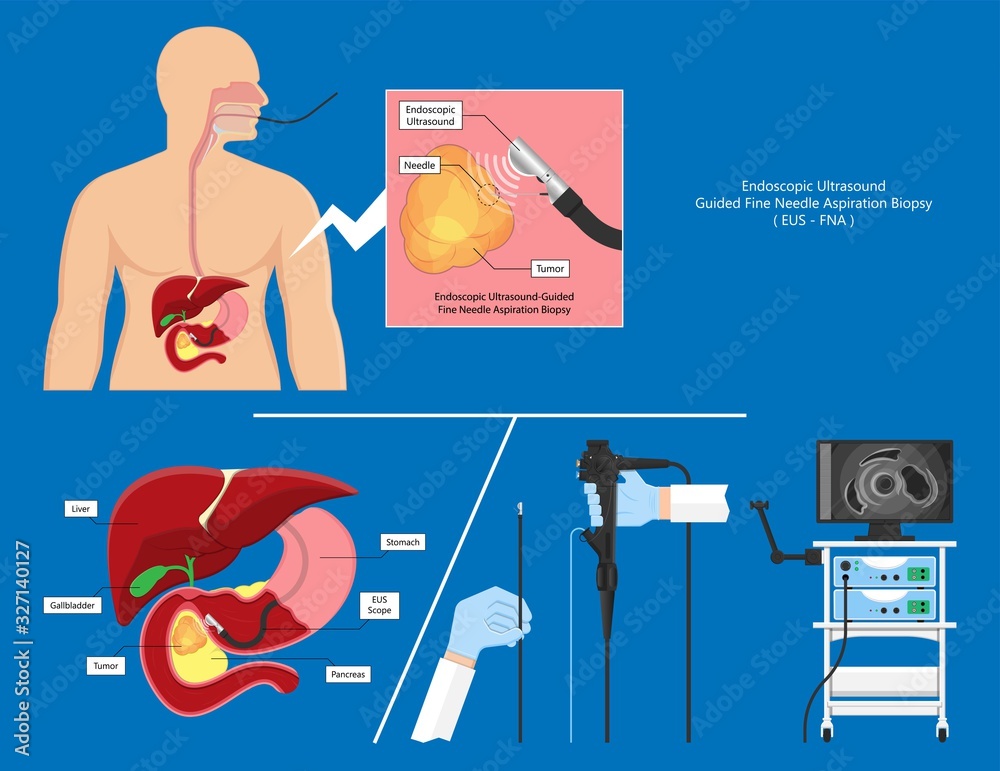 medical endoscopic ultrasound EUS cancer tumor diagnose FNA abdominal